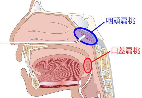 咽頭扁桃